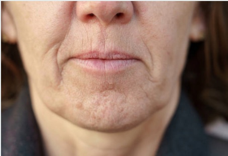 Chin Wrinkles