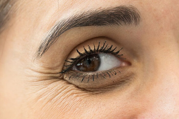 What Are Crow's Feet