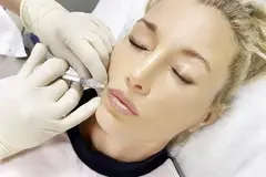 Marionette Line Filler Treatment