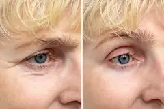Under Eyes Filler Treatment